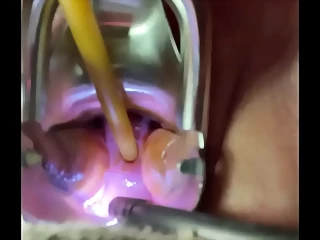 Insertion Of Semen With Syringe In Cervix Utherus After Fucking